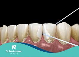 Image result for Plaque