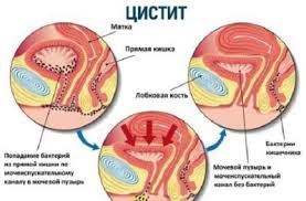 Vremenami Bespokoit Zhzhenie Pri Mocheispuskanii Vozmozhnye Zabolevaniya Diagnostika I Taktika Lecheniya Mery Profilaktiki