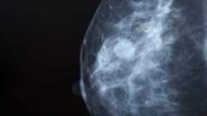 Breast Density And Breast Cancer Risk Breast Cancer