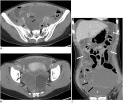 Endometriosis is defined as the presence of normal endometrial mucosa (glands and stroma) abnormally implanted in locations other than the uterine cavity (see the image below). Ruptured Left Ovarian Endometriotic Cysts In 30 Year Old Woman With Download Scientific Diagram