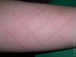 Image result for Dermatographism