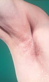 Image result for Erythrasma