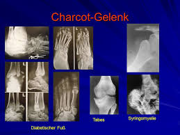 The severity of the injury can vary from simple to complex, involving many joints and bones in the midfoot. Gelenkerkrankungen Physiologie Und Pathophysiologe Des Gelenkes Ppt Video Online Herunterladen