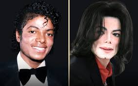 Michael Jackson's Plastic Surgery Journey