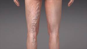 Sometimes they are swollen and raised above the surface of the skin, usually appearing on the backs of the calves or on the inside of the leg. Know About Varciose Veins Before It Turns Dangerous Health