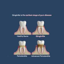 Image result for Gingivitis