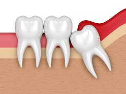 You on discovery im sure. Wisdom Tooth Removal Best Laser Dental Clinic Implant Centre
