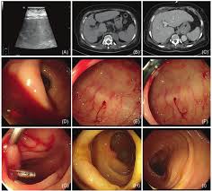 Image result for Colonoscopy in GI Bleeding
