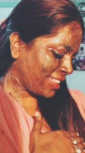 हिम्मत है तो सब है#malti #acidattackvictim #fyp #foryou #trending