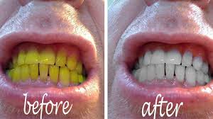 The specialist will conduct a thorough examination of the patient and ensure that it lacks any pathological manifestations. Teeth Whitening Whiten Teeth Easily At Home With Baking Soda And Lemon Youtube