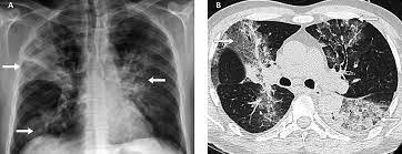 Le traitement des cancers du système respiratoire dépend du type de cancer. Legionella Pneumophila Atypisch Aber Auf Dem Vormarsch Swiss Medical Forum