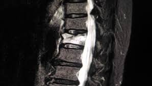 Image result for Vertebral Compression Fracture