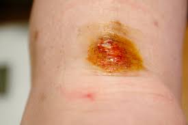 Graze gunshot wounds (those that strike the skin surface in a tangential fashion) are not uncommon. 116 Graze Wound Photos Free Royalty Free Stock Photos From Dreamstime