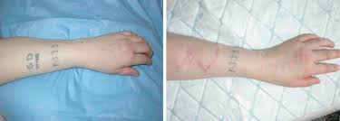 At doctors makeover, our cosmetic surgery clinic is inspected and registered with the uk for more information on surgical excision of tattoos, we have provided answers to some common questions, please click on each question below. Dealing With Tattoos In Plastic Surgery Tattoo Removal Sciencedirect