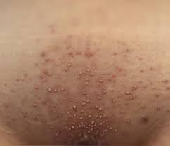 Image result for folliculitis symptoms