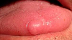 Image result for cancer of tongue