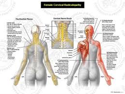 This Exhibit Depicts The Neural Anatomy Of The Upper Body And Multilevel Cervical Radiculopathy Cervical Nerve R Cervical Radiculopathy Radiculopathy Cervical