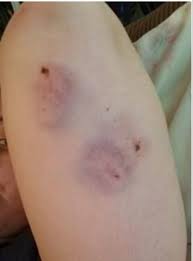 Image result for Human Bite