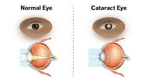 Consult a doctor for medical advice. What Are Cataracts Understanding Symptoms And Treatment