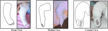 If someone has a club foot , they are born with a badly twisted foot. Ponseti Method For Clubfoot Treatment