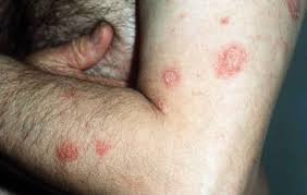 Image result for Eczema nummulare