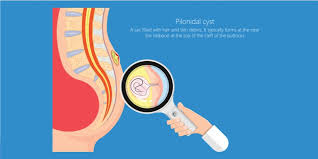 Pilonidal cysts are caused by groups of hairs and debris trapped in the pores of the skin in the upper cleft of the buttock, forming an abscess. Living With Pilonidal Sinus Things To Take Care Of Pristyn Care