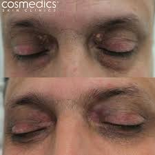 Image result for xanthelasma of eyelid