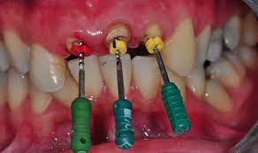 It typically takes a dentist two separate appointments to make and place a new dental crown how many canals does a canine tooth have? Root Canal Treatment Prestige Dental Care Com My