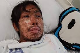 Save Nash from Steven Johnsons Syndrome