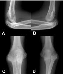 Image result for Radial Head Dislocation