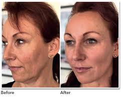 Find out your aging shop all my favorite products! Pdo Threadlift Treatment Belfast Skin Clinic