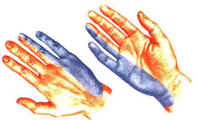 Vidno zúženú kĺbnu štrbinu, šípka ukazuje na osteofyt vo vyššom veku sa často vyskytuje aj artróza kĺbov prstov rúk (heberdenove uzly, bouchardove uzly), prípadne nôh. Stredny Nerv Ruky Nervovy System Pazi A Ruk Studium Nervoveho Vedenia