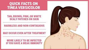 So pictures of tinea versicolor can go a long way to describing the affects it has on the skin of so many people throughout the world. Tinea Versicolor Causes Treatment Natural Remedies Femina In