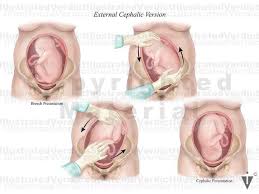 Image result for External Cephalic Version