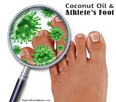 Some infected individuals may also experience dry skin recent studies indicate that tea tree oil is an effective treatment for athlete's foot and it may offer less side effects, compared to traditional. Coconut Oil For Athlete S Foot Tinea Pedis Hybrid Rasta Mama