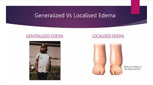 Image result for Localized Edema