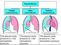 Image result for Open Pneumothorax