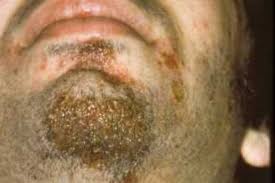 Image result for yellow scabs on the face in children