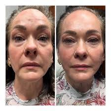 🌙let's play another guessing game for a prize! What did this patient have  done? Before and after photos were taken 1 hour apart Comment Below ⬇️  Winner will be announced tomorrow (1/11/24) at 5pm
