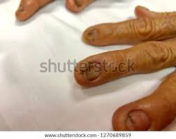 Image result for Koilonychia feet