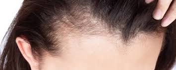 Image result for Alopecia