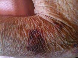 Those areas where we get the most sun is where our skin thins the actinic and solar both mean sun. Actinic Purpura Dermatology Advisor