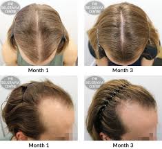 Filling the online form was so easy as was getting an appointment for an online consultation via zoom. Hair Growth Success Over The Moon With My Results