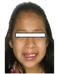 4/4/2014 Paciente con compromiso de labio y paladar hendido, tratamiento  ortodóntico http://www.ortodoncia.ws/publicaciones/201