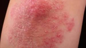 A psoríase é uma doença inflamatória de pele, mediada por células t, hereditária, que sofre influência ambiental. Sus Oferece Mais Quatro Medicamentos Para Tratar Psoriase Radio Ubaense 104 1 Fm