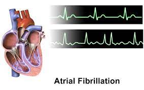 Atrial Fibrillation Risk Assessment Changes Over Time | American Council on  Science and Health