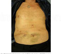 Check spelling or type a new query. Figure 5 From Laparoscopic Liver Surgery Semantic Scholar