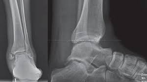 Broken ankles are painful and temporarily disabling. Preoperative X Rays Of A 32 Year Old Man With An Isolated Medial Download Scientific Diagram