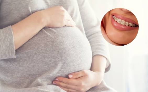 Đang mang thai có niềng răng được không? Có ảnh hưởng đến thai nhi không? -  Đang mang thai có niềng răng được không? Có ảnh hưởng đến thai nhi không?Tin  tức