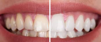 Bleaching Coburg Zahnaufhellung Dr Wulf Dr Jacob
